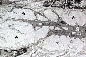 M,60y. | jejunum - amyloidosis